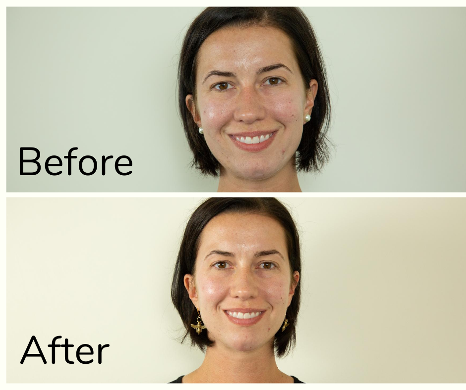 Before and after photo of my first chemical peel