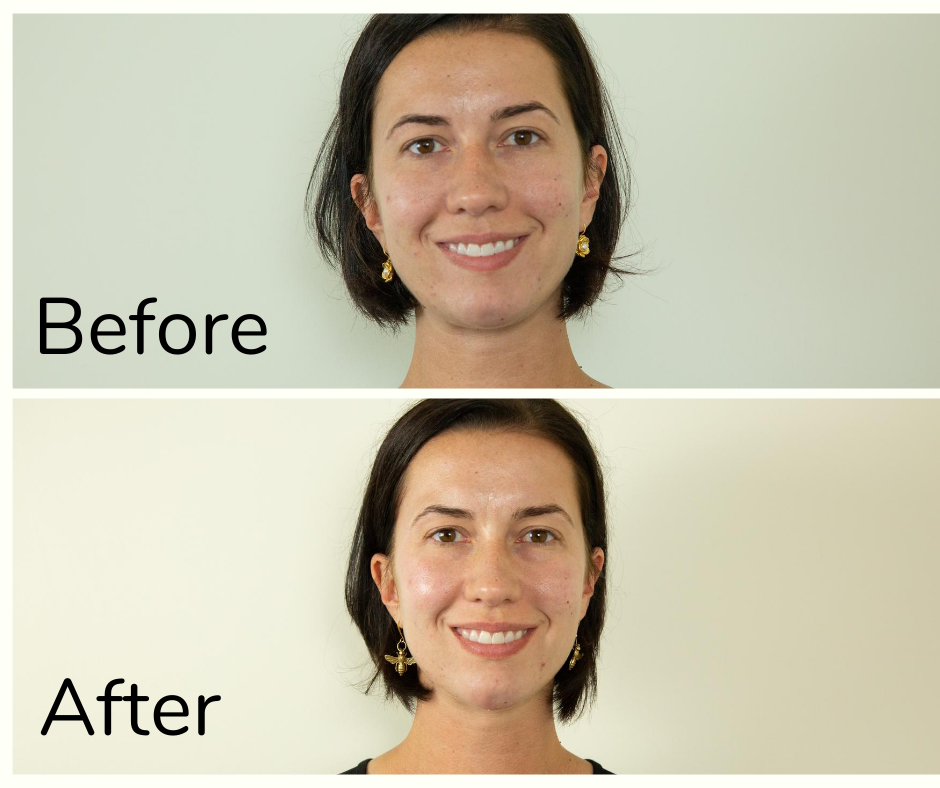 Before and after photo of my first chemical peel