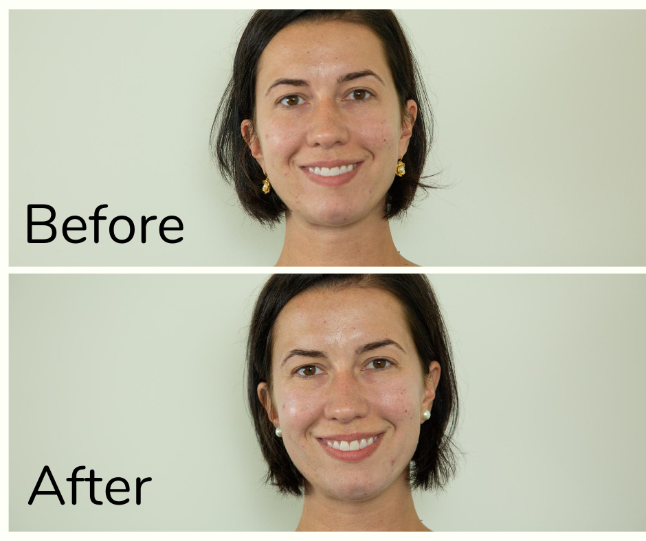 Before and after photo of my first chemical peel