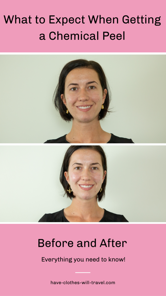 Before and After a Chemical Peel: What to Expect + Photos