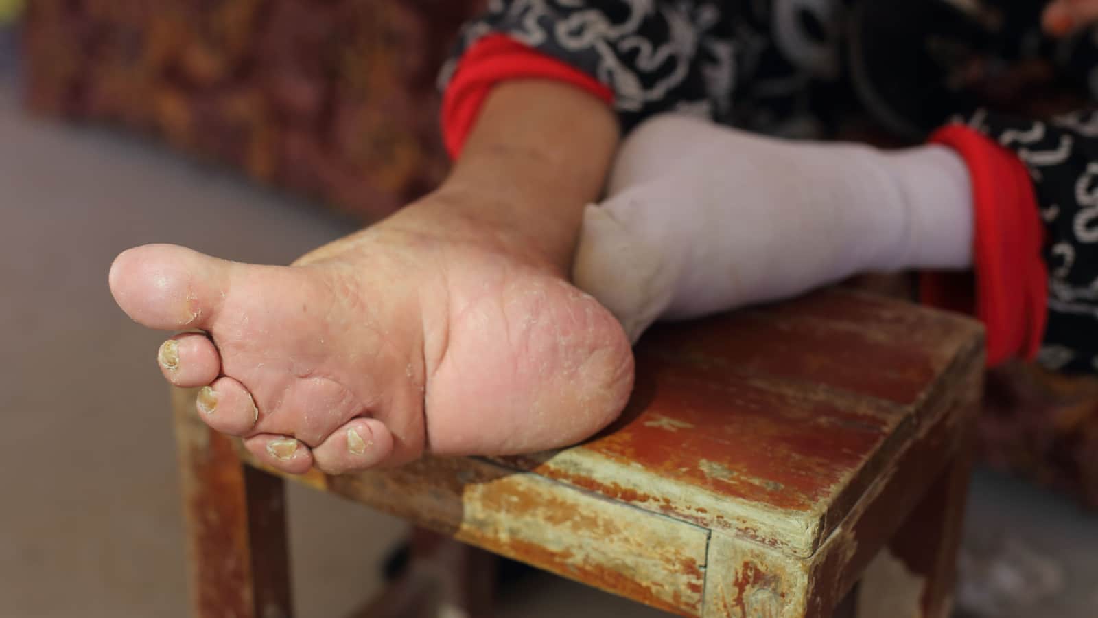 Close up of bound foot of a 97 years old Chinese old woman, born in 1919, the last generation that bind the feet of woman