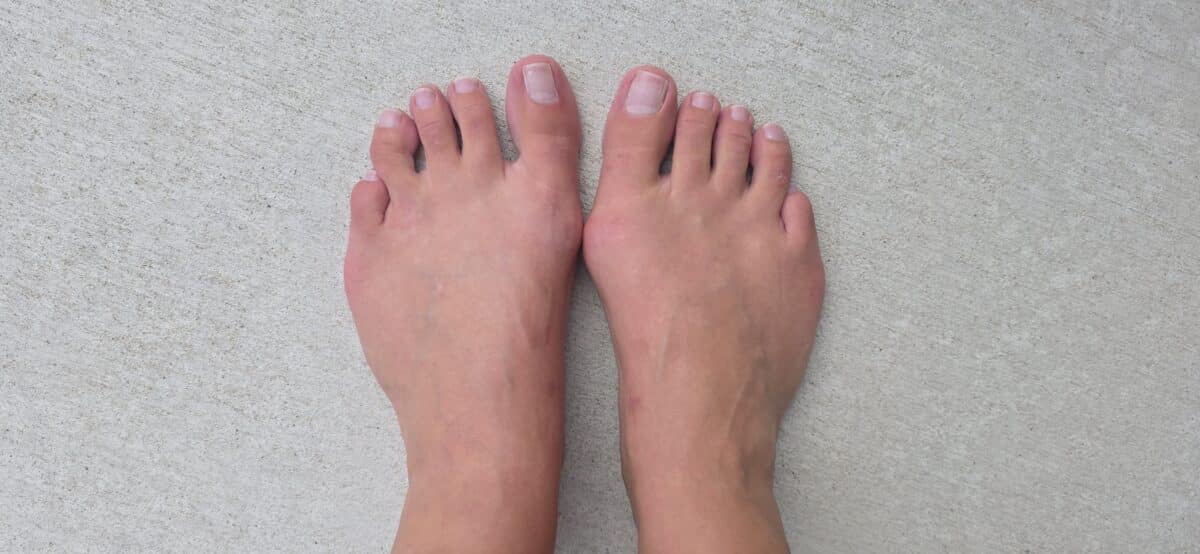My feet (bunion is on the right foot)